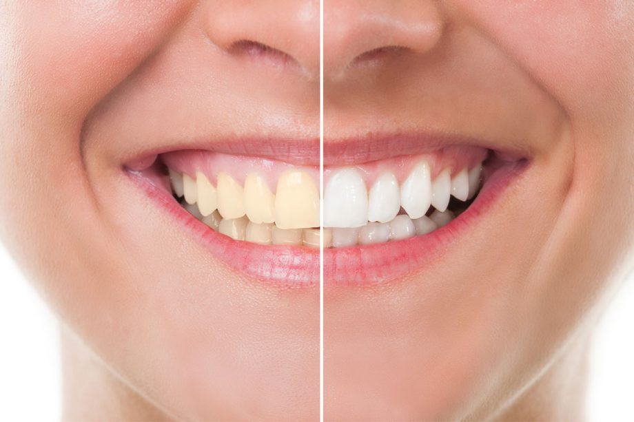 before and after teeth whitening