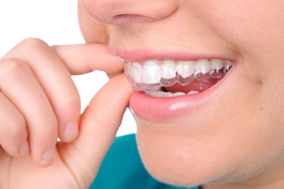patient inserts an Invisalign clear aligner tray into mouth